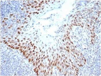 IHC staining of FFPE human tonsil tissue with SOX2 antibody (clone SOX2/4267R) at 2ug/ml in PBS for 30min RT. Strong nuclear staining observed. HIER: boil tissue sections in pH 9 10mM Tris with 1mM EDTA for 20 min and allow to cool before testing.