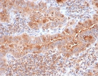 IHC staining of FFPE human thyroid with Calcitonin antibody (clone CALCA/3310). HIER: boil tissue sections in pH 9 10mM Tris with 1mM EDTA for 20 min and allow to cool before testing.