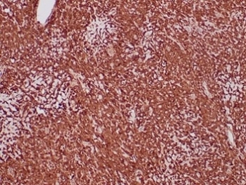IHC staining of FFPE human sarcoma tissue with Aldehyde Dehydrogenase 1A1 antibody (clone ALDH1A1/4793) at 2ug/ml. HIER: boil tissue sections in pH 9 10mM Tris with 1mM EDTA for 20 min and allow to cool before testing.