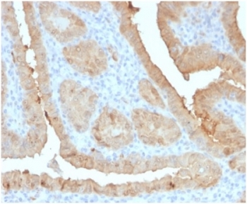 IHC staining of FFPE human thyroid carcinoma with LGALS3 antibody (clone LGALS3/4792). HIER: boil tissue sections in pH 9 10mM Tris with 1mM EDTA for 20 min and allow to cool before testing.