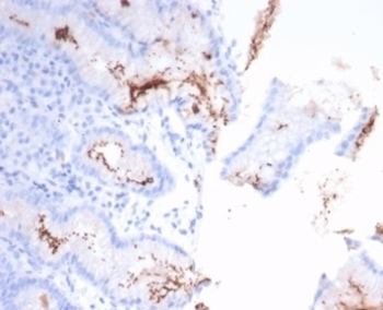 IHC staining of H. pylori-infected FFPE human stomach tissue with Helicobacter pylori antibody (clone HPYL/7226). HIER: boil tissue sections in pH 9 10mM Tris with 1mM EDTA for 20 min and allow to cool before testing.